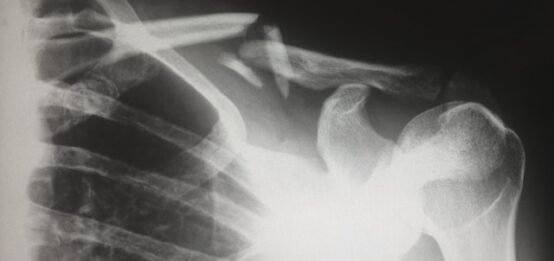 X Ray Shoulder Bones Radiography